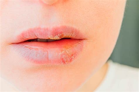 O que causa o herpes labial?